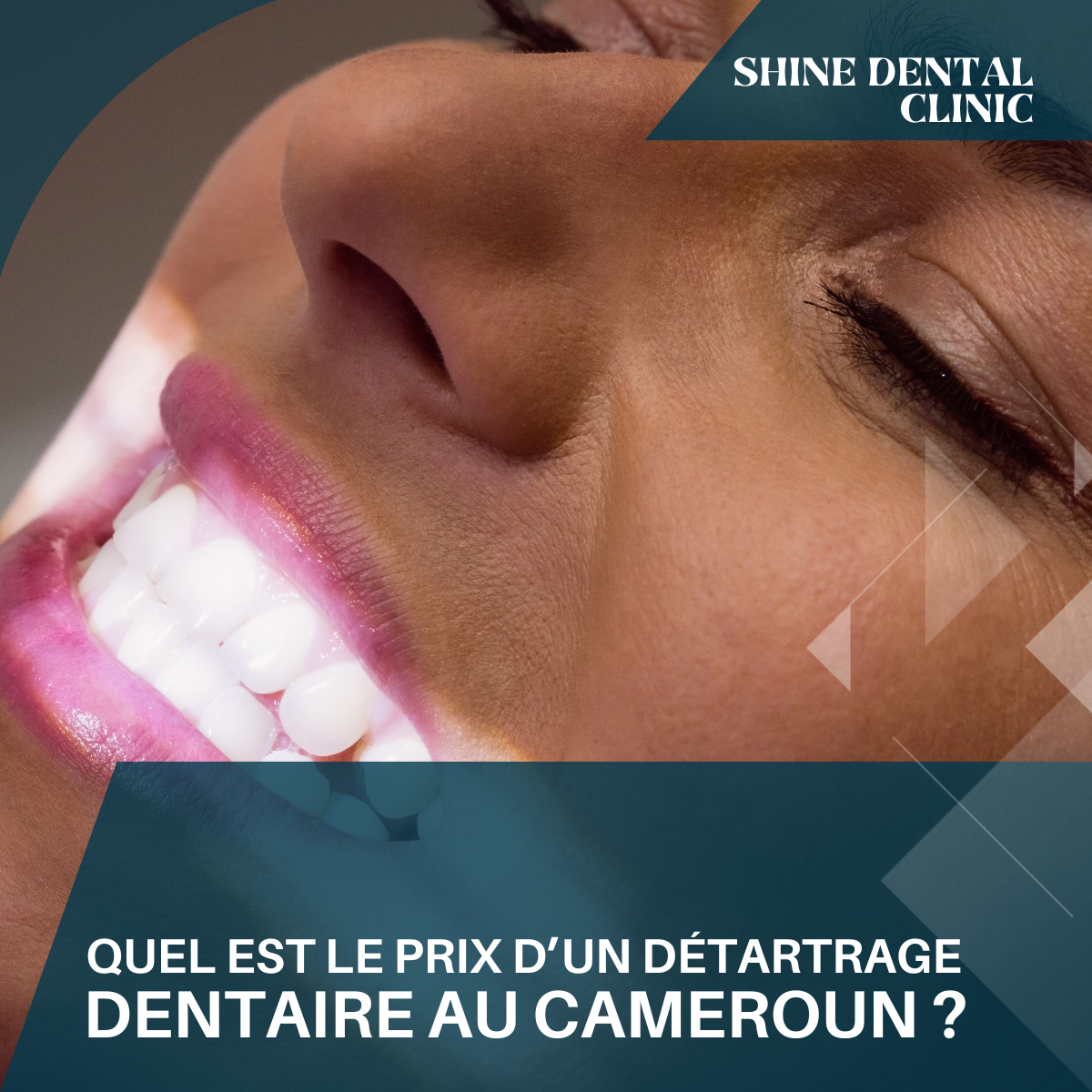 Quel est le prix d’un détartrage dentaire au Cameroun ?