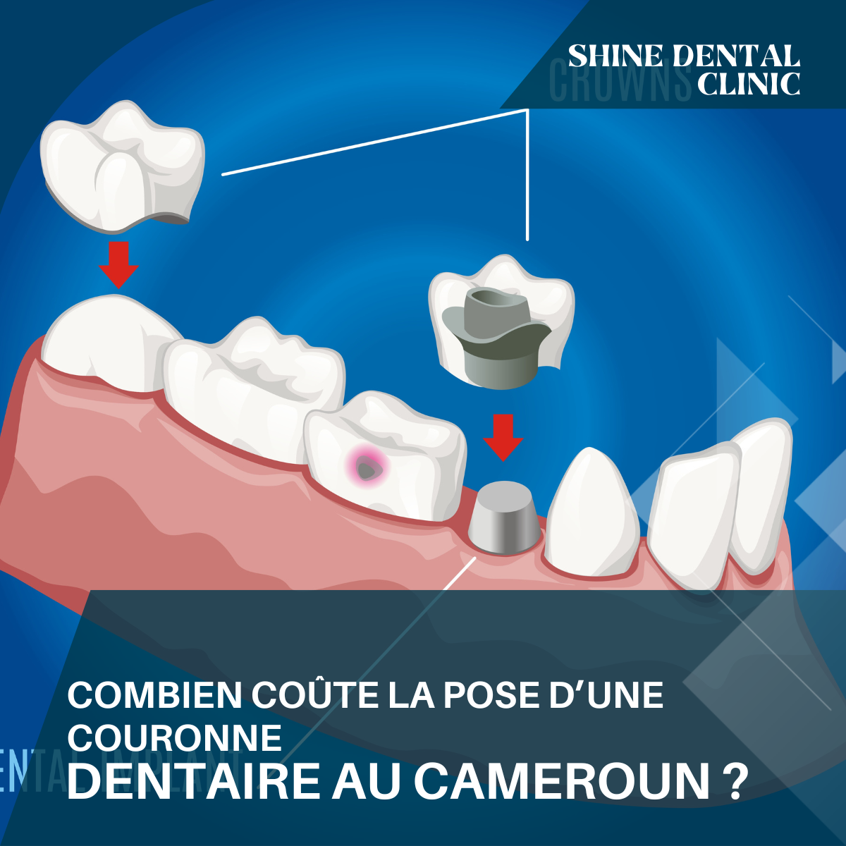 Combien coûte la pose d’une couronne dentaire au Cameroun ?
