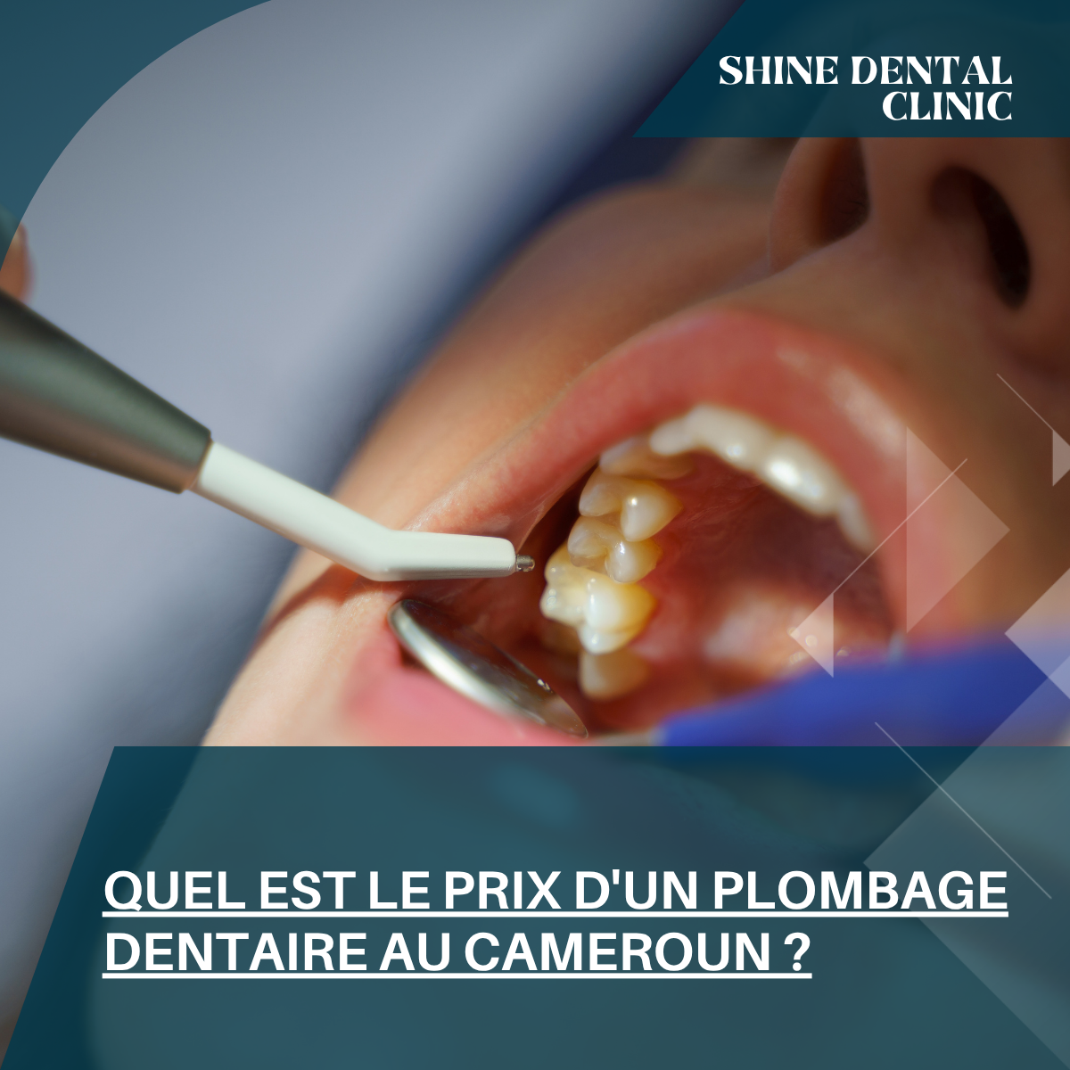 Quel est le prix d'un plombage dentaire au Cameroun ?